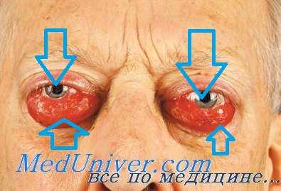 гистиоцитома глаза