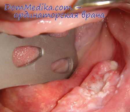 опухоли у детей