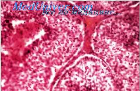 Злокачественная цилиндрома