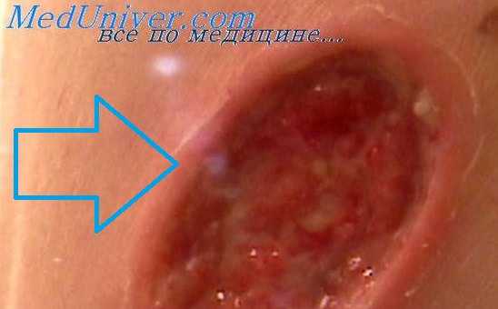 аденокарцинома