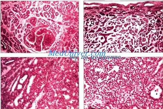 Аденоидно-кистозный эккринный рак