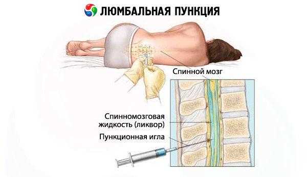 Взрослым люмбальную пункцию обычно проводят в промежутке L3-L4