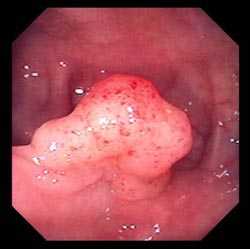 Полип в толстом кишечнике (тубулярная аденома)