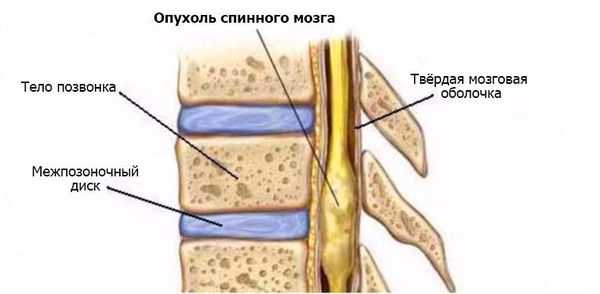 Опухоли спинного мозга