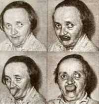 Нейролептический синдром