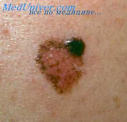опухоль кожи