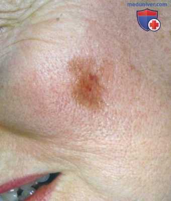 Злокачественное лентиго