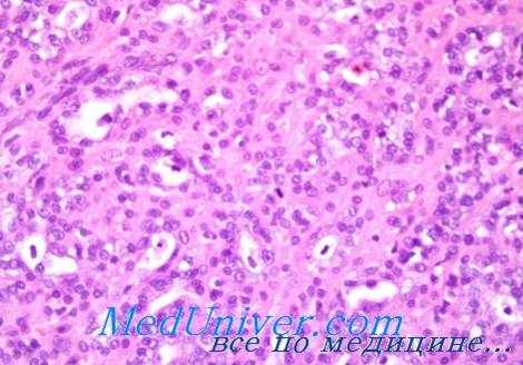 аденогенный рак век