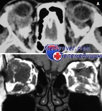 аденогенный рак век