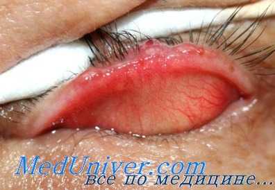 аденогенный рак век