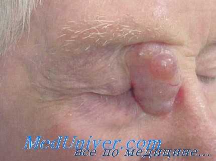 аденогенный рак век