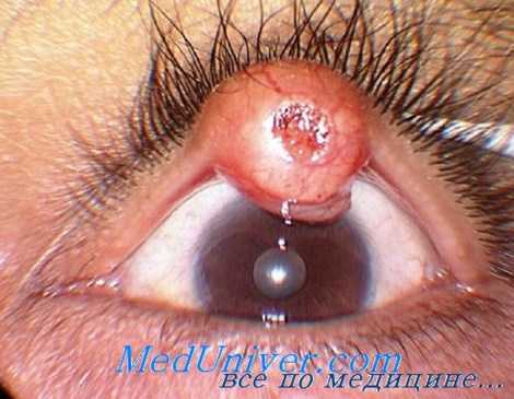 классификация рака век