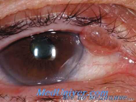 классификация рака век