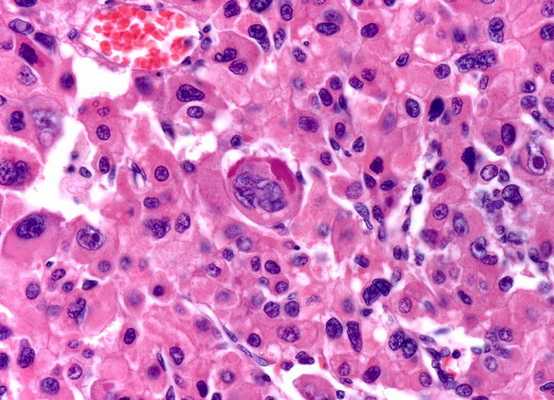 Промежуточные филаменты - значение в медицине