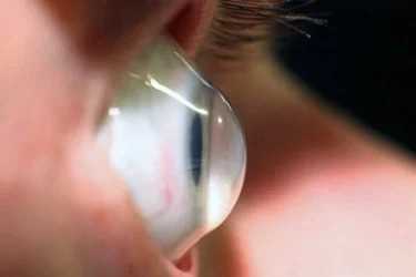 Кератоконус - заболевание роговицы глаза