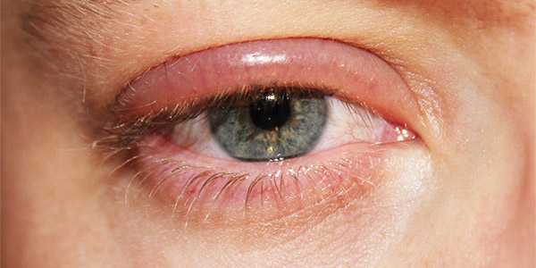Вирусный блефарит глаза