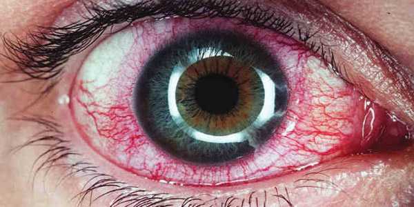 Вирусный увеит глаза