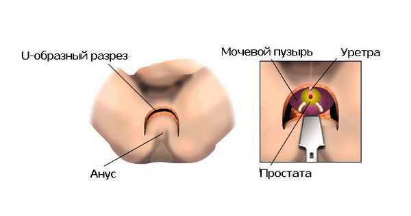 После послойного рассечения тканей и визуализации предстательной железы и семенных пузырьков, хирург приступает к их удалению.