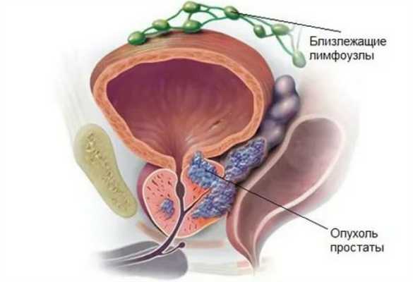 Рак простаты