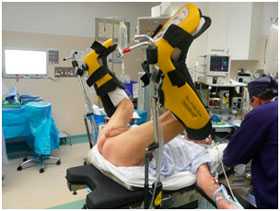 Открытая перинеальная простатэктомия выполняется в верхнем литотомическом положении, как показано на рисунке.