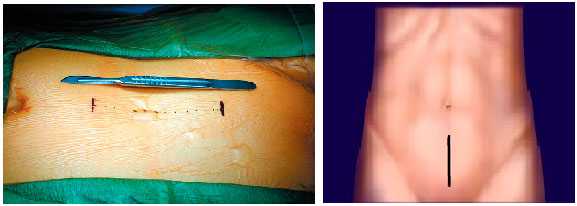 При необходимости перед простатэктомией может проводиться и лимфаденэктомия - удаление регионарных лимфатических узлов. 