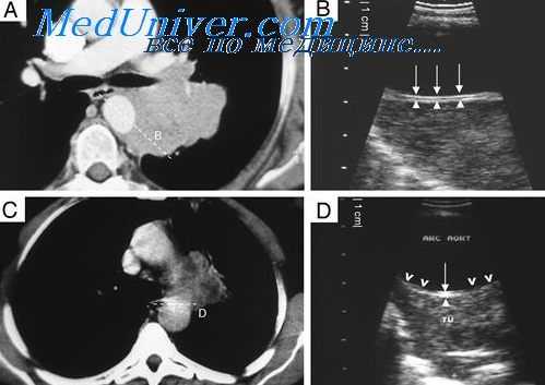 рентгенотерапия опухолей средостения