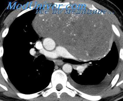 лимфосаркомы средостения
