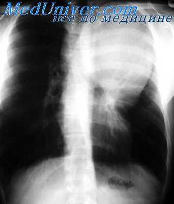 лучевая терапия опухоли