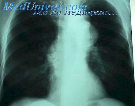 аневризма аорты