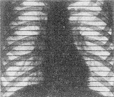 Рис. 4. Рентгенокимограмма сердца и магистральных сосудов в норме: амплитуда зубцов на контурах сердца и магистральных сосудов отражает их пульсацию.