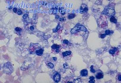 туберкулезные спайки