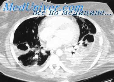 деструктивная пневмония