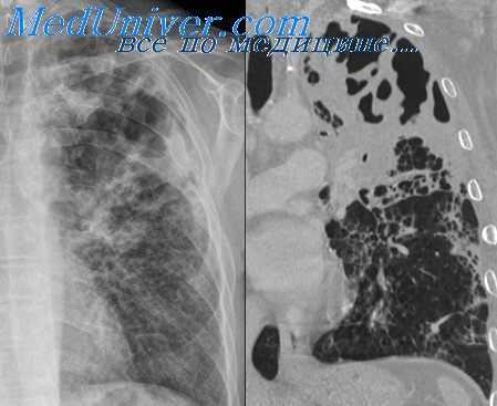 деструктивная пневмония