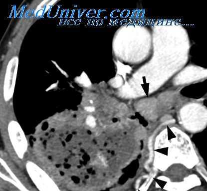 внутрилегочное введение лекарств