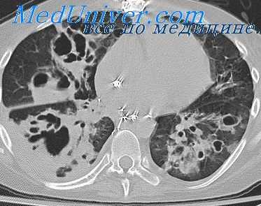 деструктивная пневмония