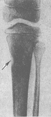 Рис. 2. Рентгенограмма голени: видна Лоозера зона перестройки диафиза большеберцовой кости, похожая на картину коркового абсцесса (указана стрелкой).