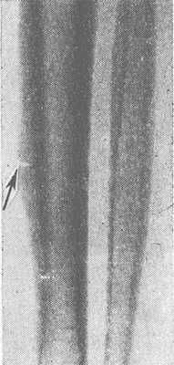 Рис. 1. Рентгенограмма голени: видна Лоозера зона в корковом слое большеберцовой кости в виде полоски просветления, имитирующей неполный перелом (указана стрелкой).