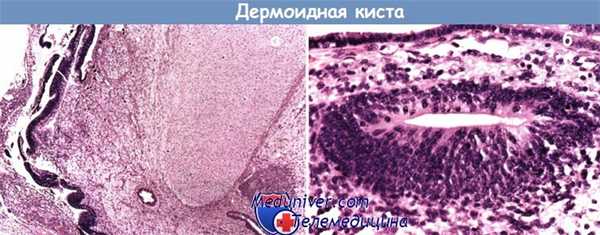 Дермоидная киста - зрелая кистозная тератома