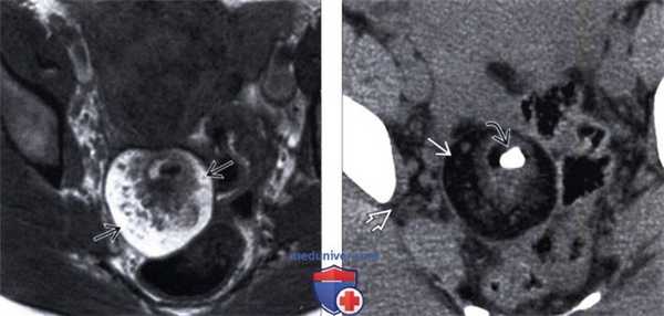 Методы обследования тератомы яичника