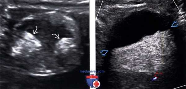 Методы обследования тератомы яичника