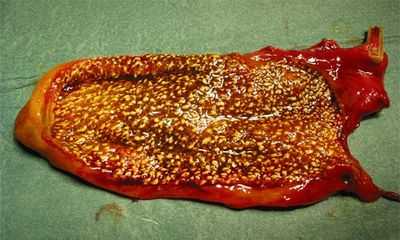 Полипозная форма холестероза