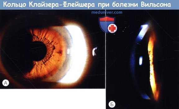 Кольцо Кайзера-Флейшера при болезни Вильсона