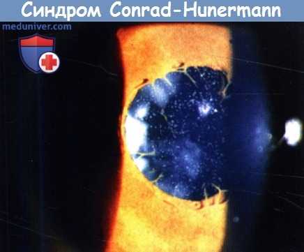 Катаракта при синдроме Conrad-Hunermann
