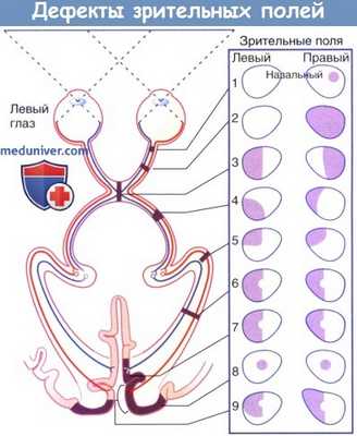 Дефекты зрительных полей
