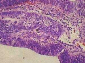 Тубулярная аденома