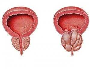 Зубчатая аденома