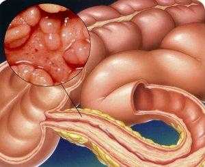 Тубулярная аденома прямой кишки