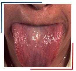 Увеличение языка у пациента с амилоидозом. Источник: http://www.mayoclinic.com