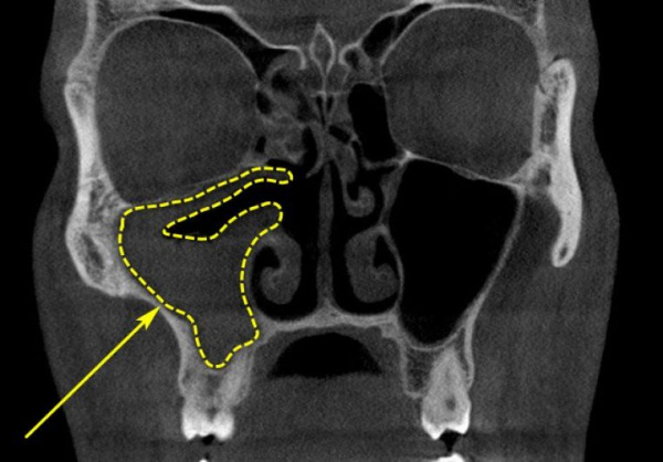 Одонтогенный гайморит