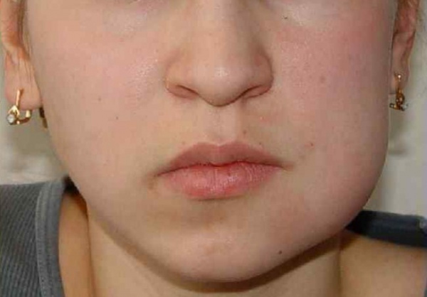 Одонтогенная инфекция